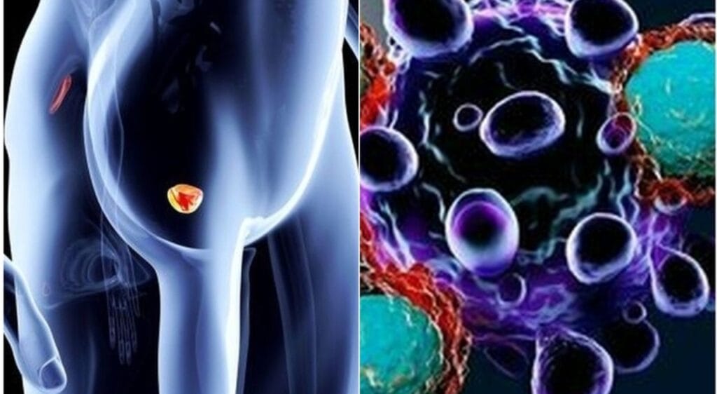 La mia lezione sul tumore alla prostata silenzioso