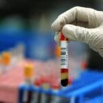 Scoperto test che identifica precocemente 50 tumori